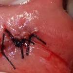 fibroma 3